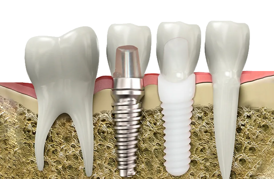 Dental İmplant Cerrahisi: Kayıp Dişlerin Kalıcı ve Güvenilir Çözümü