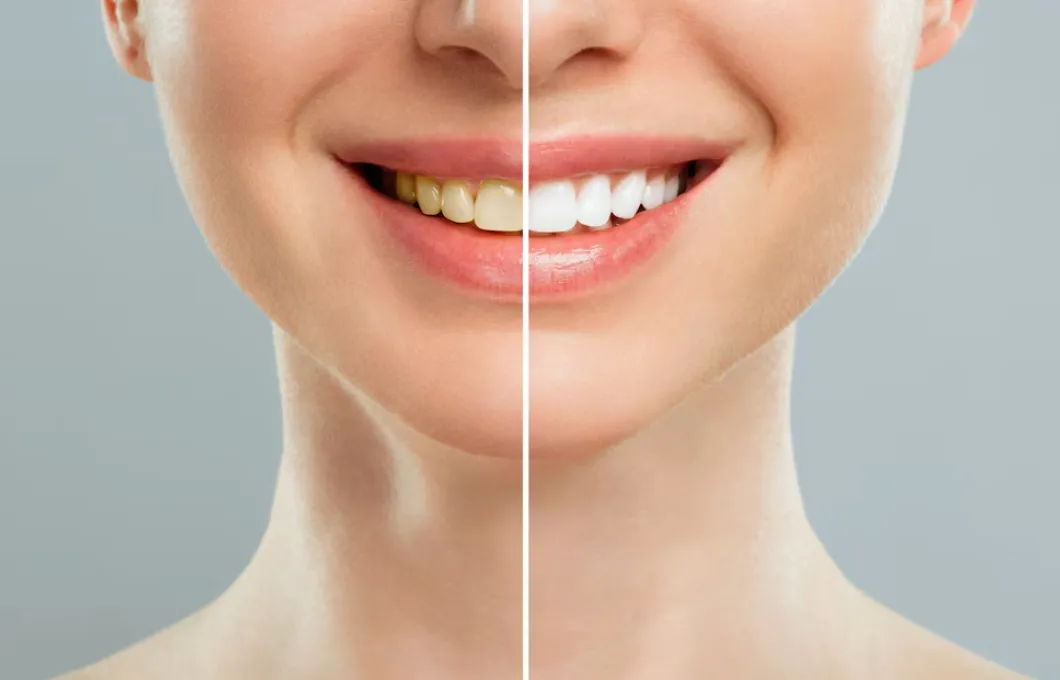 Diş Beyazlatmanın Psikolojik Etkisi